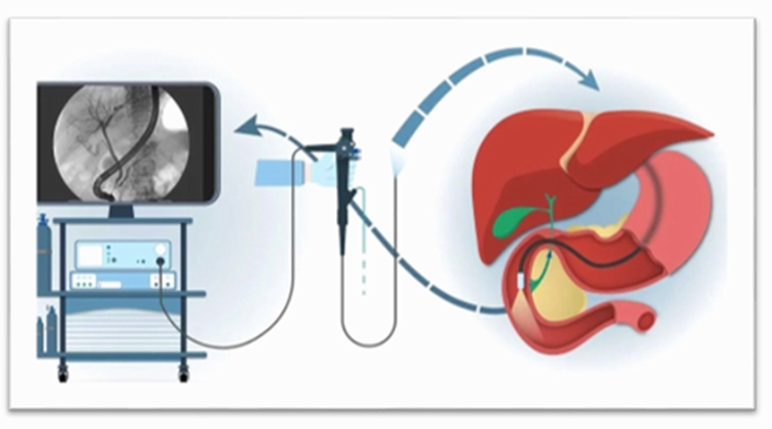 روش آندوسونوگرافی در تشخیص و درمان ضایعات گوارش با فوق تخصص گوارش و کبد بالغین ، استاد گروه گوارش و کبد